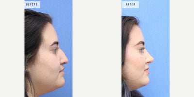 Rhinoplasty before and after photo