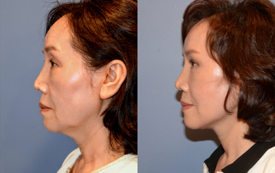 Deep Plane Facelift before and after photo