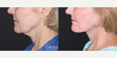 before and after image