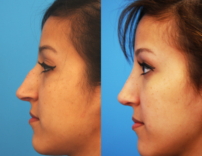 Rhinoplasty before and after photo