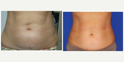 Velashape before and after photo
