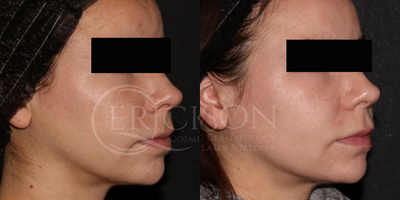 Halo Laser before and after photo