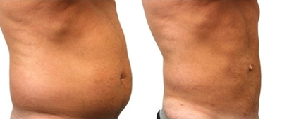 Liposuction before and after photo