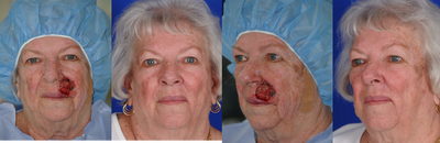 Facial Reconstructive Surgery before and after photo