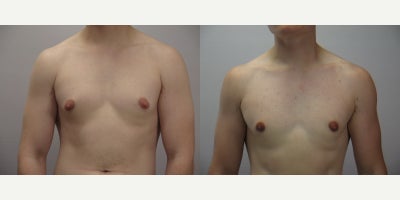 Gynecomastia Surgery before and after photo