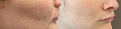 Microneedling before and after photo