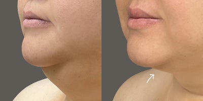 before and after image