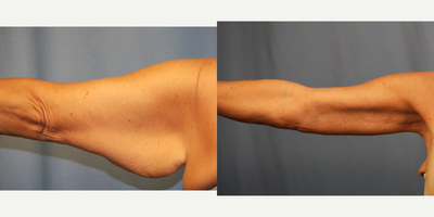 Arm Lift before and after photo