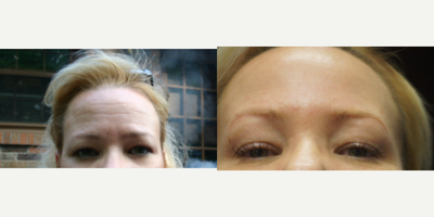 Botox before and after photo