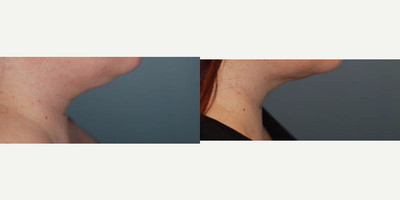 Chin Liposuction before and after photo