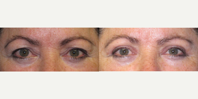 Eyelid Surgery before and after photo