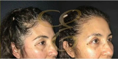 Eyelid Surgery before and after photo