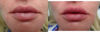 Restylane Silk before and after photo
