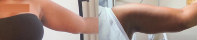Skin Tightening before and after photo