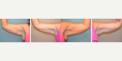 Smart Lipo before and after photo