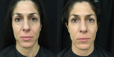 Voluma before and after photo