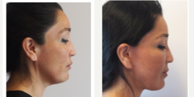 Facelift before and after photo