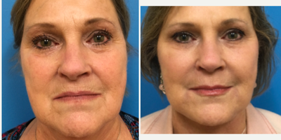 Juvederm before and after photo