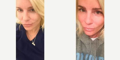 Microneedling before and after photo