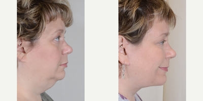 Neck Lift before and after photo