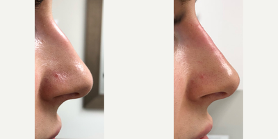 Restylane before and after photo