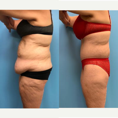 Body Lift before and after photo