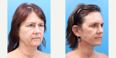 Facelift before and after photo