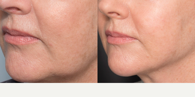 Kybella before and after photo