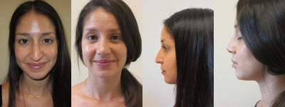 Rhinoplasty before and after photo