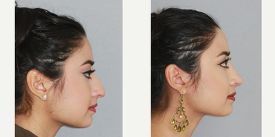 Rhinoplasty before and after photo