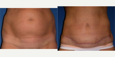 Tummy Tuck before and after photo