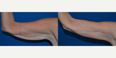 Arm Lift before and after photo