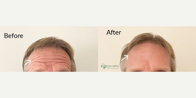 Botox before and after photo