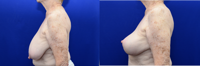 Breast Lift before and after photo