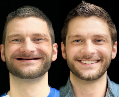 Dental Implants before and after photo