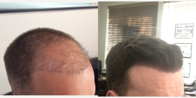 Hair Transplant before and after photo
