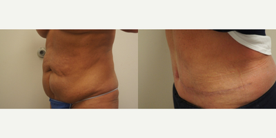 Tummy Tuck before and after photo