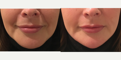 Voluma before and after photo