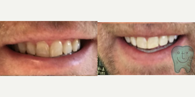 Zoom Whitening before and after photo