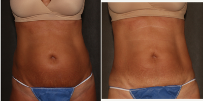 CoolSculpting before and after photo