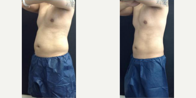 CoolSculpting before and after photo