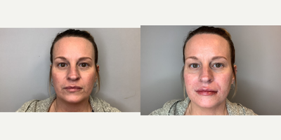 Lip Fillers before and after photo
