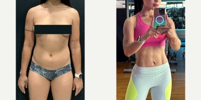 Liposculpture before and after photo