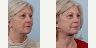 Rhinoplasty before and after photo