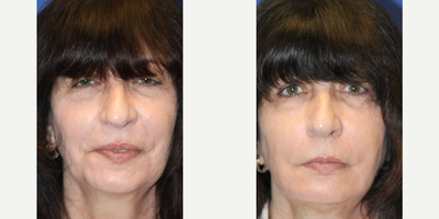 Bellafill before and after photo