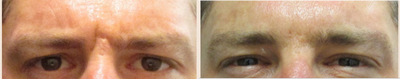 Botox before and after photo