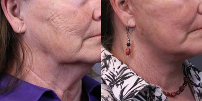 CO2 Laser before and after photo