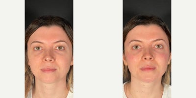 Dermal Fillers before and after photo