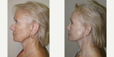Facelift before and after photo