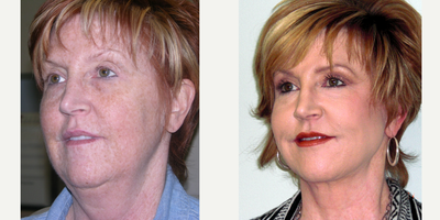 Facelift before and after photo